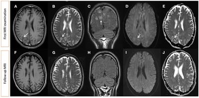 Case report: Reversible encephalopathy caused by dyskinesia-hyperpyrexia syndrome